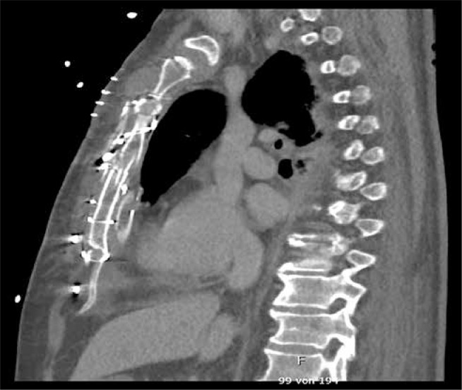 Extensive chest wall stabilization after cardiopulmonary resuscitation and urgent cardiac surgery.