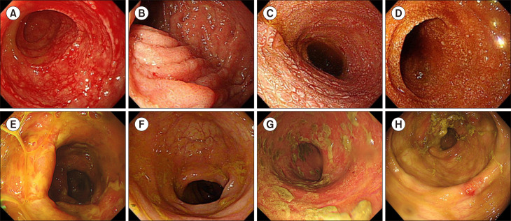 Fecal microbiota transplantation for steroid-refractory gastrointestinal graft-versus-host disease.