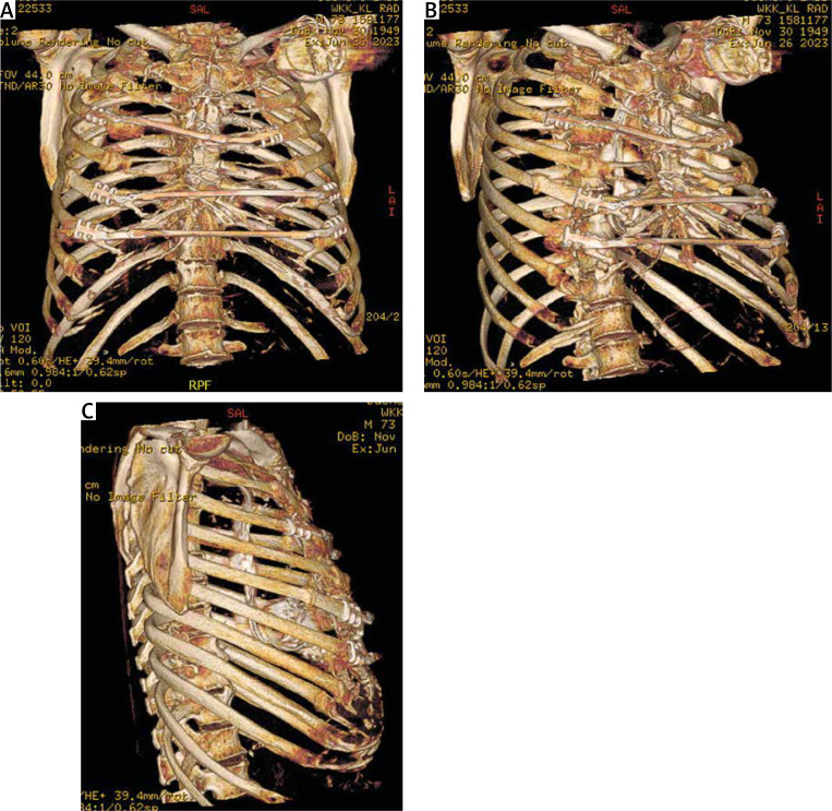 Extensive chest wall stabilization after cardiopulmonary resuscitation and urgent cardiac surgery.