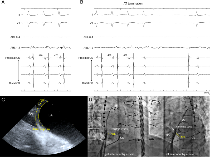 Intra-septal radiofrequency ablation within the transseptal puncture hole targeting an interatrial connection during a bi-atrial tachycardia