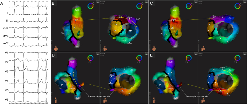 Intra-septal radiofrequency ablation within the transseptal puncture hole targeting an interatrial connection during a bi-atrial tachycardia