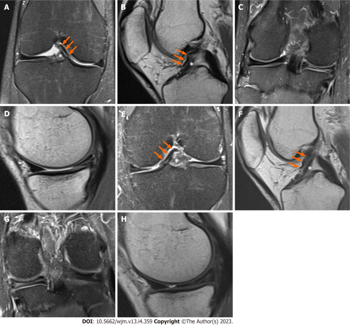 Clinical, imaging, arthroscopic, and histologic features of bilateral anteromedial meniscofemoral ligament: A case report.