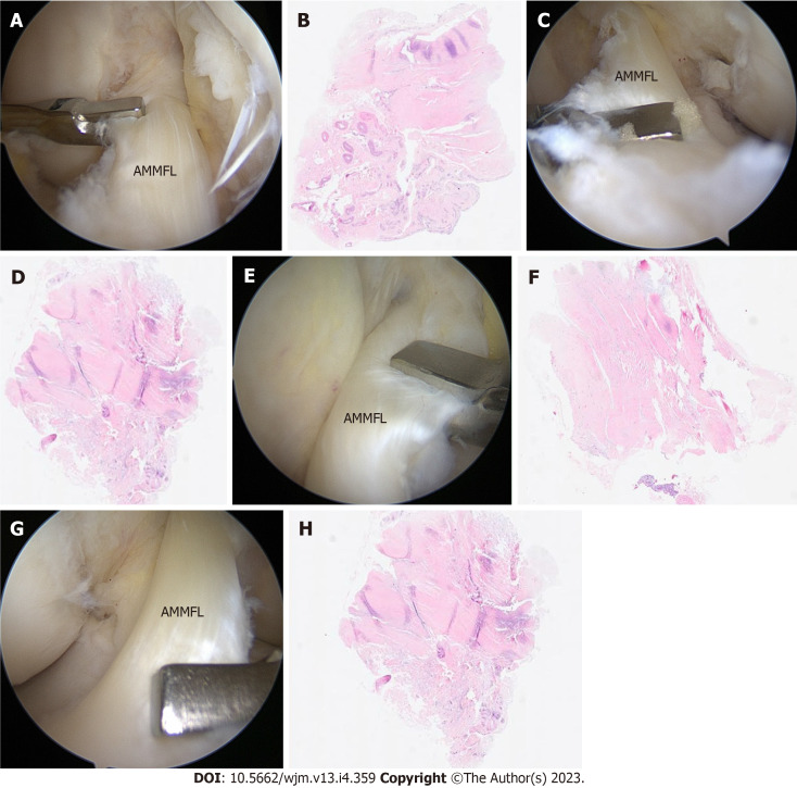 Clinical, imaging, arthroscopic, and histologic features of bilateral anteromedial meniscofemoral ligament: A case report.