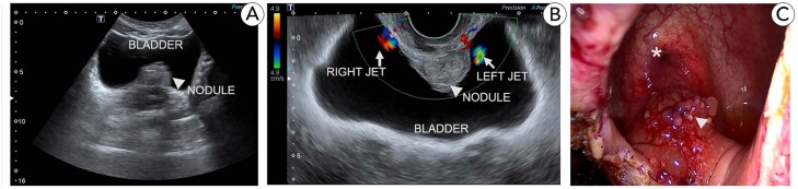 A nomogram to predict the absence of clinically significant prostate cancer in males with negative MRI