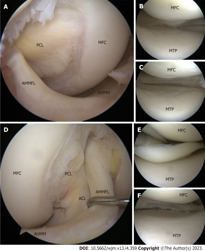 Clinical, imaging, arthroscopic, and histologic features of bilateral anteromedial meniscofemoral ligament: A case report.