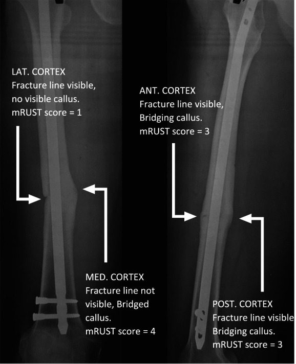 Predictors of nonunion for transverse femoral shaft fractures treated with intramedullary nailing: a SIGN database study.