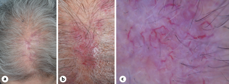 Primary Cutaneous Marginal Zone Lymphoma following Repeated Inflammation Caused by Hair Dyeing.