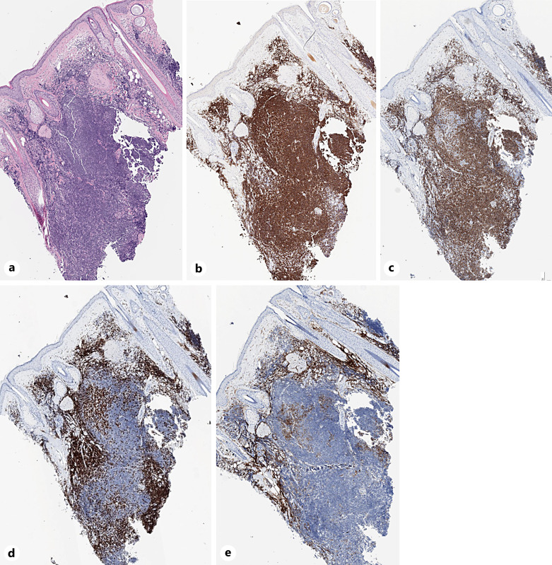 Primary Cutaneous Marginal Zone Lymphoma following Repeated Inflammation Caused by Hair Dyeing.