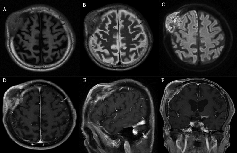 A Primary Intraosseous Meningioma: A Rare Case of Malignancy with High Proliferative Ability.