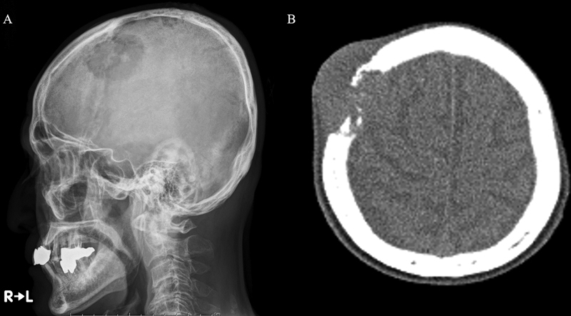 A Primary Intraosseous Meningioma: A Rare Case of Malignancy with High Proliferative Ability.