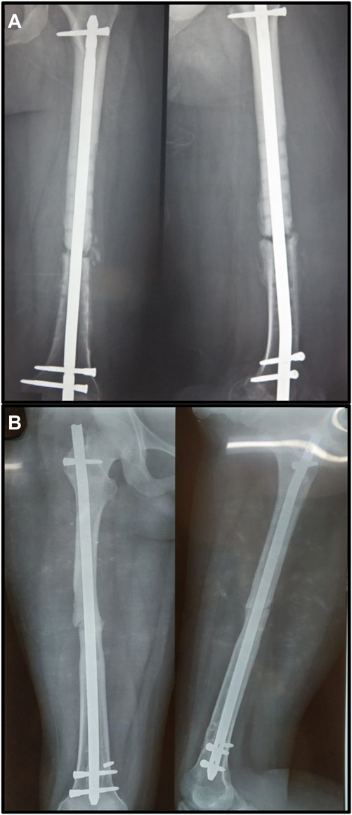 Predictors of nonunion for transverse femoral shaft fractures treated with intramedullary nailing: a SIGN database study.