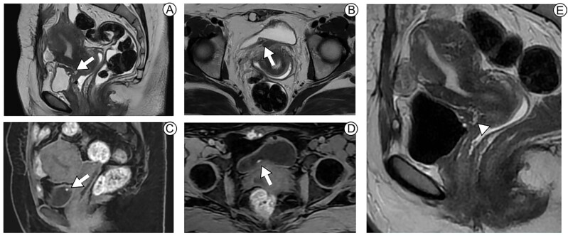 A nomogram to predict the absence of clinically significant prostate cancer in males with negative MRI