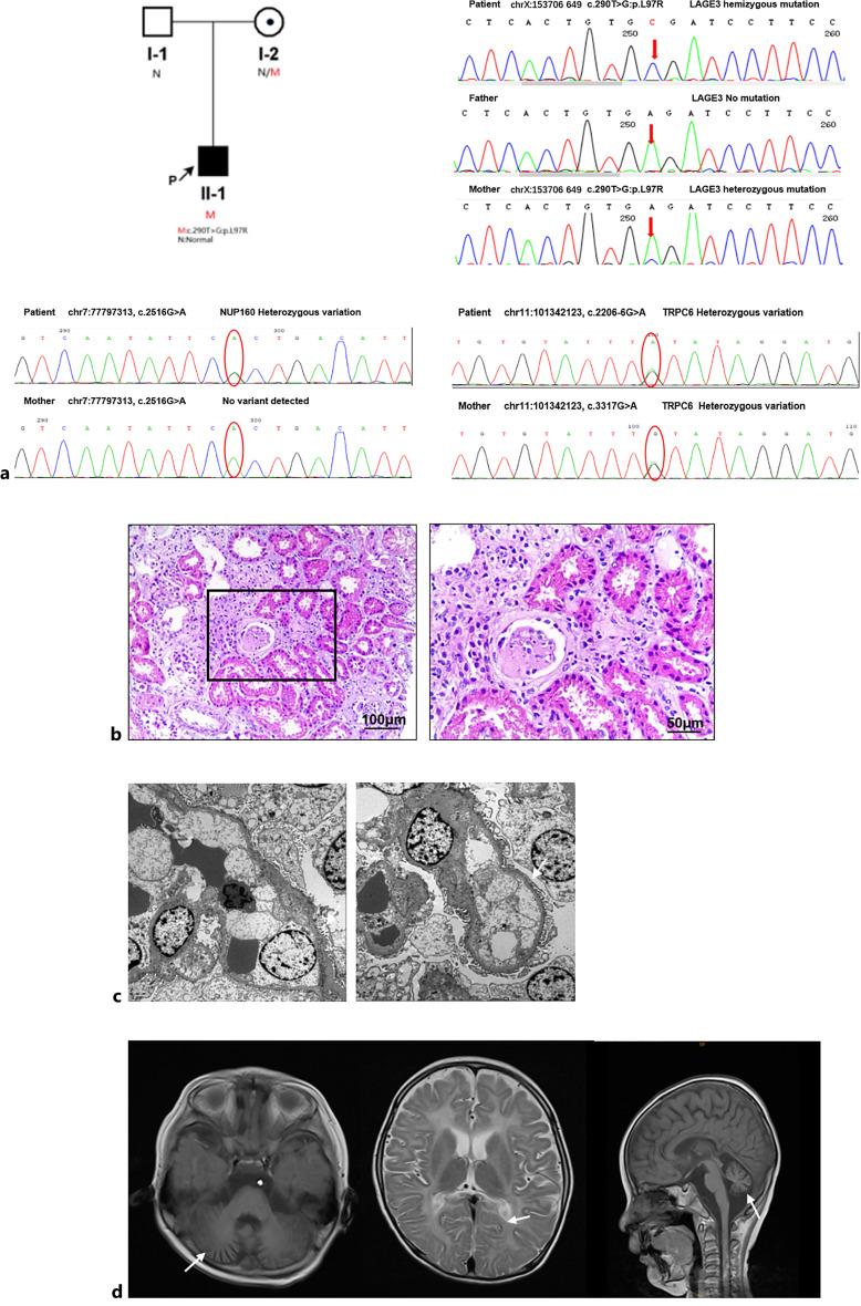 Novel LAGE3 Pathogenic Variants Combined with TRPC6 and NUP160 Variants in Galloway-Mowat Syndrome: A Case Report.