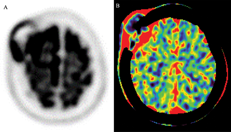 A Primary Intraosseous Meningioma: A Rare Case of Malignancy with High Proliferative Ability.