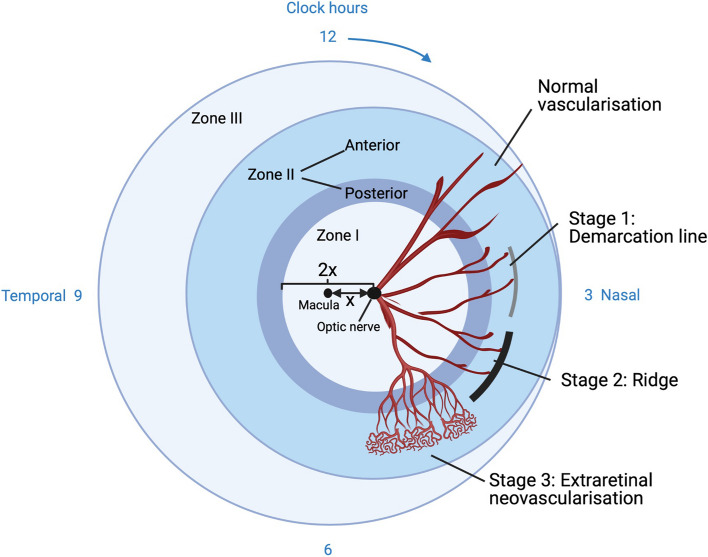 Retinopathy of prematurity: from oxygen management to molecular manipulation.