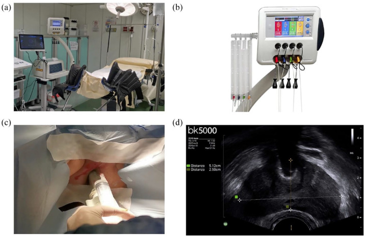 Transperineal laser ablation as a new minimally invasive surgical therapy for benign prostatic hyperplasia: a systematic review of existing literature.