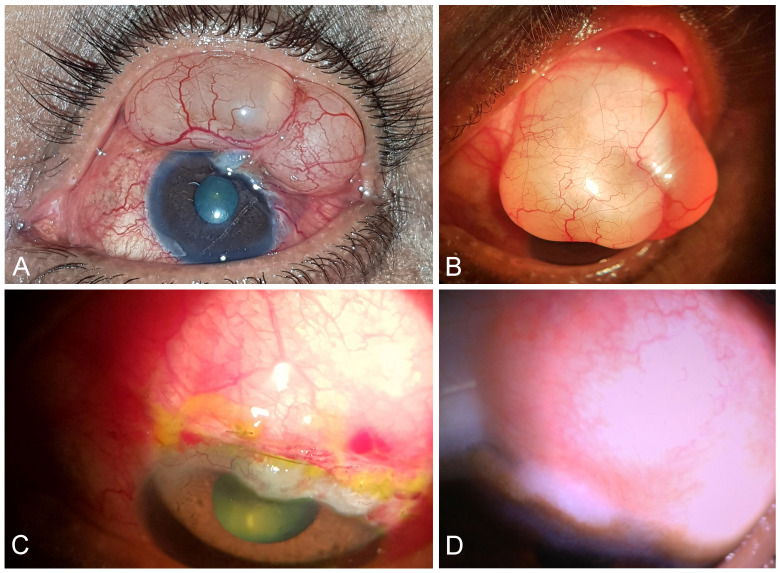 Recurrence of gigantic overhanging bleb post excision: a case report.