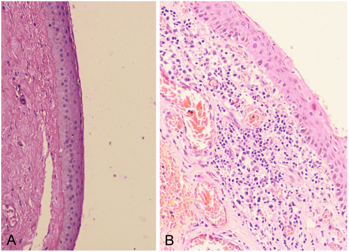 Recurrence of gigantic overhanging bleb post excision: a case report.