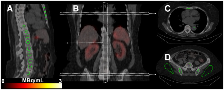 Specific Uptake in the Bone Marrow Causes High Absorbed Red Marrow Doses During [<sup>177</sup>Lu]Lu-DOTATATE Treatment.