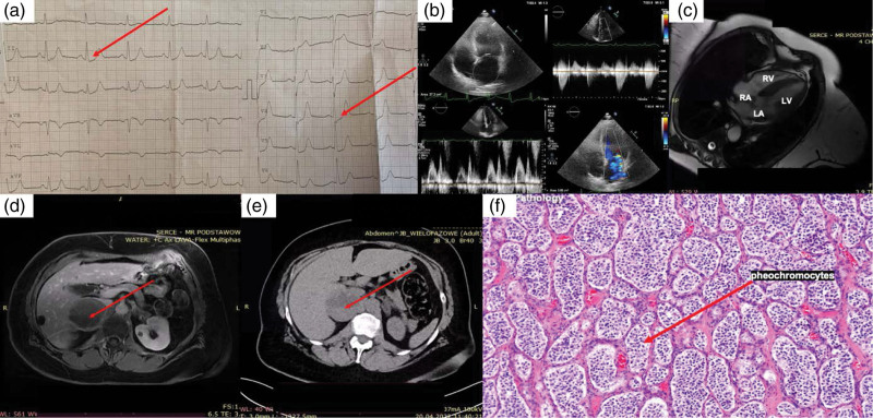 Takotsubo syndrome with several hypertensive crises: an unexpected diagnosis.