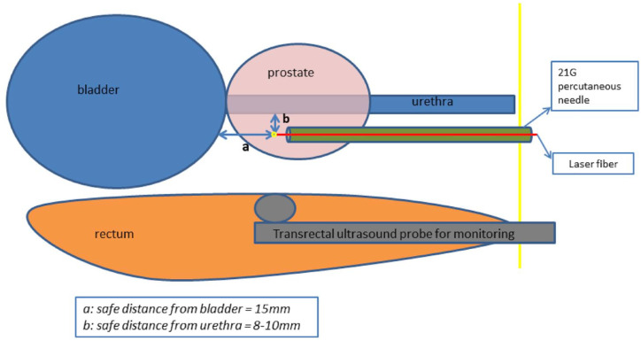 Transperineal laser ablation as a new minimally invasive surgical therapy for benign prostatic hyperplasia: a systematic review of existing literature.