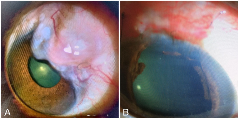 Recurrence of gigantic overhanging bleb post excision: a case report.