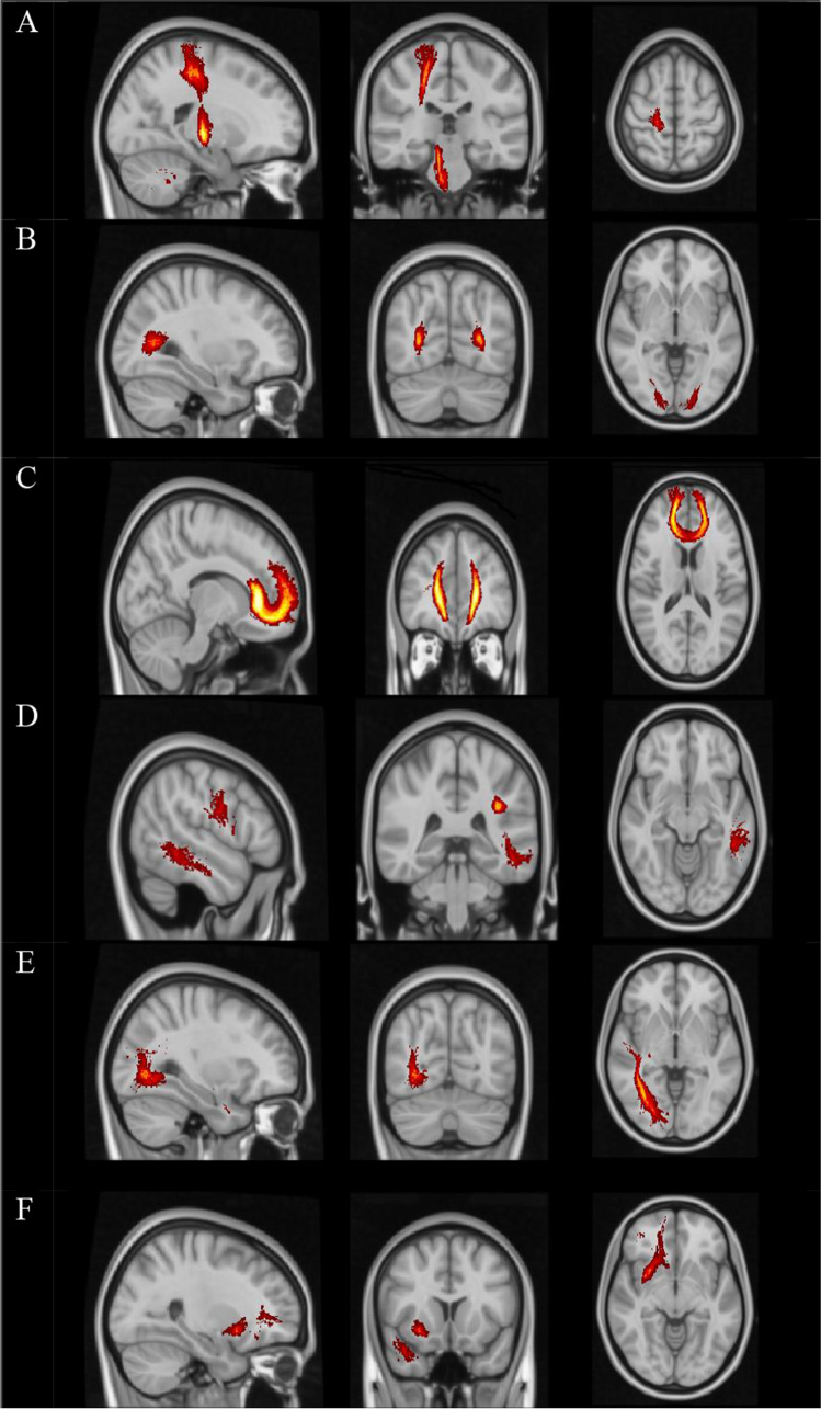 The association between white matter tract structural connectivity and information processing speed in relapsing-remitting multiple sclerosis.