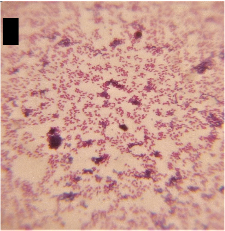 Disseminated Gonococcal Infection Caused by a Multidrug-Resistant Pathogen Presenting with Hemorrhagic Manifestation: A Case Report.