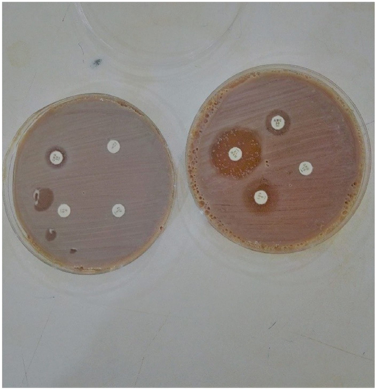 Disseminated Gonococcal Infection Caused by a Multidrug-Resistant Pathogen Presenting with Hemorrhagic Manifestation: A Case Report.