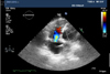 Veno-arterial extracorporeal membrane oxygenation for post-infarction ventricular septal defect in a low-volume center.