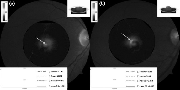 Evaluation of Macular Pigment Optical Density in Eyes with Hyperopic Anisometropic Amblyopia Using Fundus Reflectometry.