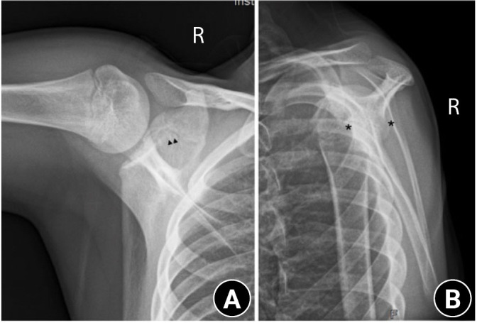 Normal ossification of the glenoid mimicking a glenoid fracture in an adolescent patient: a case report.