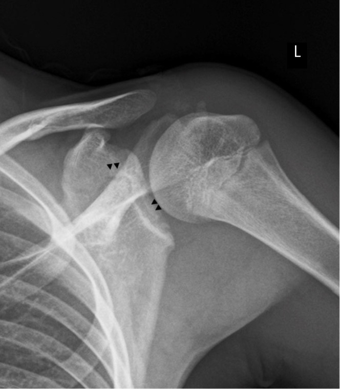 Normal ossification of the glenoid mimicking a glenoid fracture in an adolescent patient: a case report.