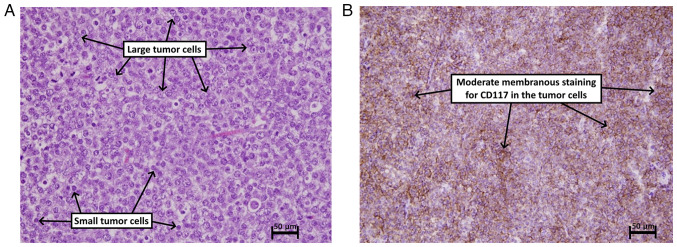 Spermatocytic tumor of the testis: A case report and mini‑review of the literature.