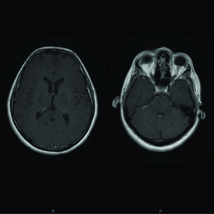 Human herpesvirus-7 meningitis in an immunocompetent adult patient: a case report.