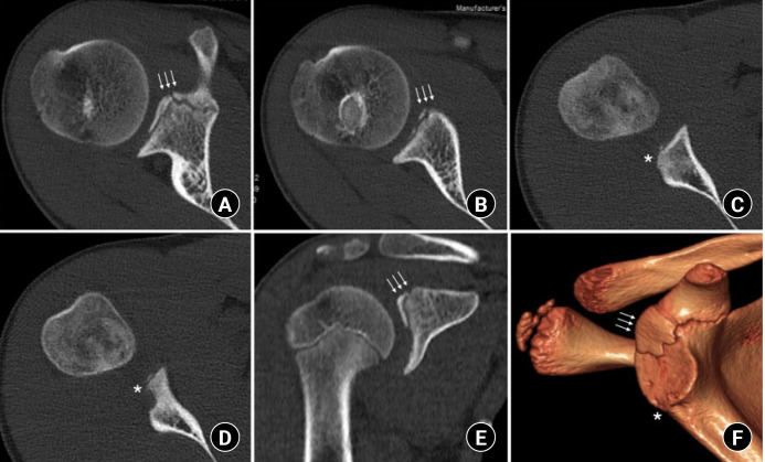 Normal ossification of the glenoid mimicking a glenoid fracture in an adolescent patient: a case report.