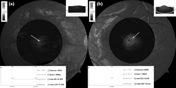 Evaluation of Macular Pigment Optical Density in Eyes with Hyperopic Anisometropic Amblyopia Using Fundus Reflectometry.