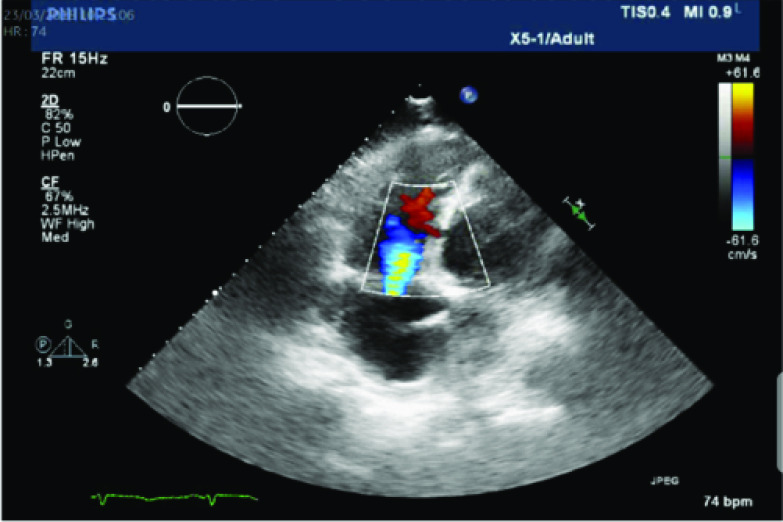 Veno-arterial extracorporeal membrane oxygenation for post-infarction ventricular septal defect in a low-volume center.