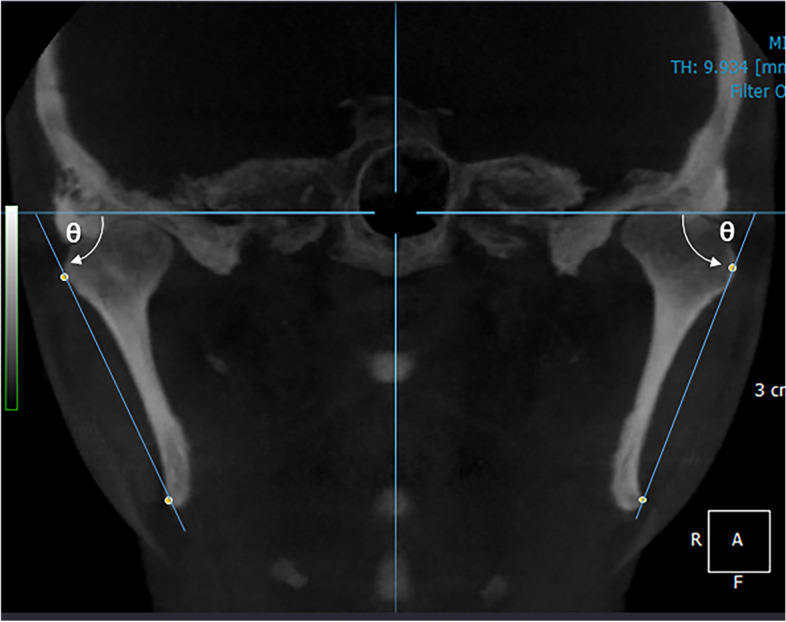 3D simulation of interosseous interference in sagittal split ramus osteotomy for mandibular asymmetry.