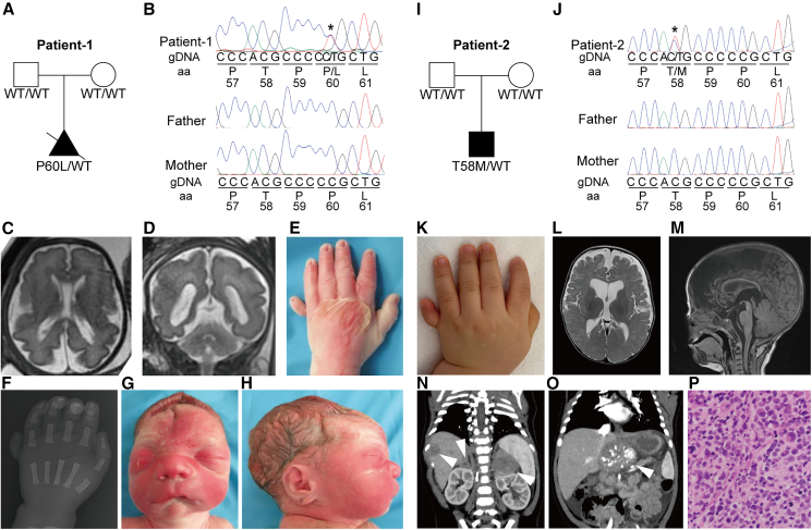 Gain-of-function MYCN causes a megalencephaly-polydactyly syndrome manifesting mirror phenotypes of Feingold syndrome.