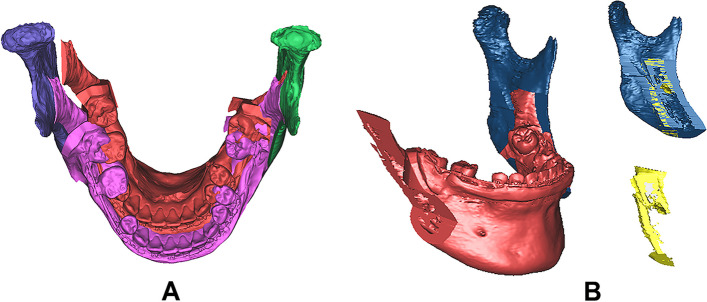 3D simulation of interosseous interference in sagittal split ramus osteotomy for mandibular asymmetry.