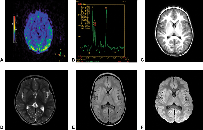 Possible Role of Mitochondrial Transfer RNA Gene 5816 A > G Genetic Polymorphism (m.5816A > G) in a 3-Year-Old Child with Dystonia: Report of a Case.