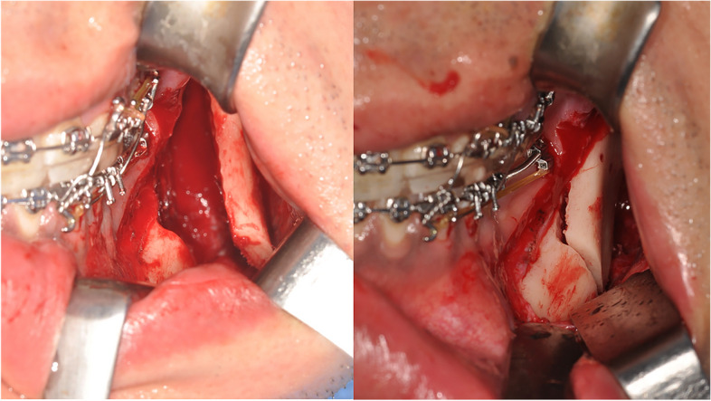 3D simulation of interosseous interference in sagittal split ramus osteotomy for mandibular asymmetry.