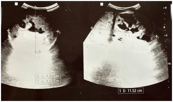 Spermatocytic tumor of the testis: A case report and mini‑review of the literature.