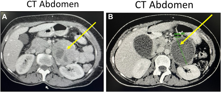 Hypertensive Crisis in a Patient With a Functioning Mesenteric Paraganglioma: Dramatic Response to Octreotide Treatment