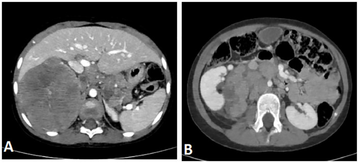 Mandibular Metastasis in Neuroblastoma in a 3 Year-Old Child: A Case Report.