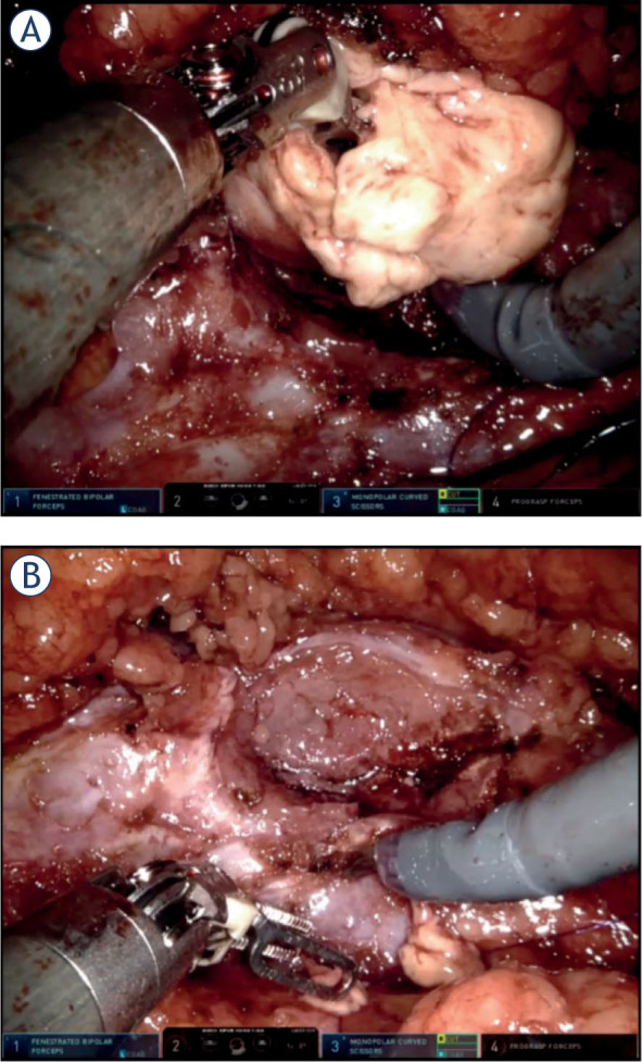 Does tumor rupture during robot-assisted partial nephrectomy have an impact on mid-term tumor recurrences?