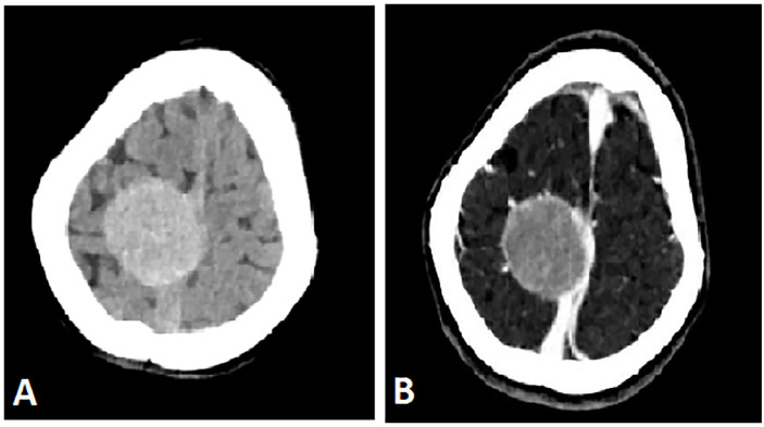 Mandibular Metastasis in Neuroblastoma in a 3 Year-Old Child: A Case Report.