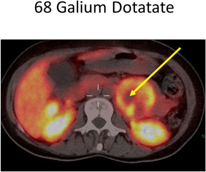 Hypertensive Crisis in a Patient With a Functioning Mesenteric Paraganglioma: Dramatic Response to Octreotide Treatment