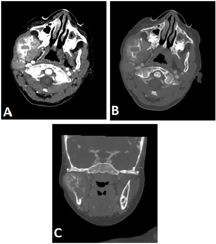 Mandibular Metastasis in Neuroblastoma in a 3 Year-Old Child: A Case Report.